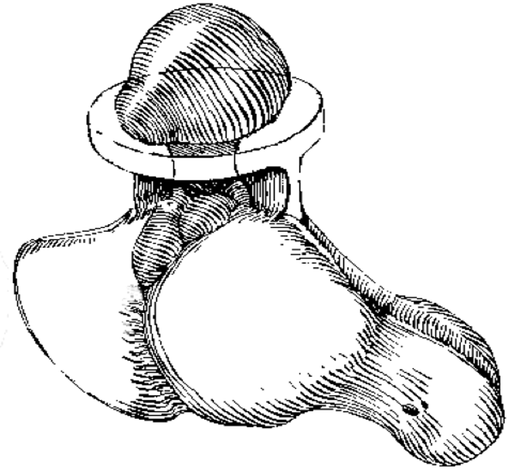 <p>fluid filled lump under the skin</p><p>arises from joint capsule, tendon sheath or ligament </p>