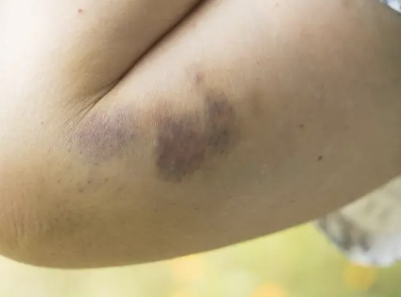 <p>A closed soft-tissue injury where the skin is intact but underlying blood vessels are damaged, causing bleeding into the tissues</p><ul><li><p>Assess ABCs</p></li><li><p>Treat for <strong>possible internal injury/shock</strong> if MOI is significant</p></li><li><p>Cold pack (not directly on skin)</p></li><li><p>Monitor</p></li></ul><p></p>