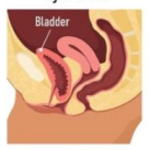 <p>Anterior bladder prolapse, which is herniation of the anterior vaginal wall associated with descent of the bladder </p><p>-Presentation: bulge or pressure symptoms, stress urinary incontinence, low back or pelvic pain, sexual dysfunction, can be exacerbated by pregnancy </p><p>-Dx: pelvic exam, POP-Q, increase in defect with valsalva, U/S or MRI </p><p>-Management: vaginal pessary, pelvic floor muscle exercises, surgery </p>