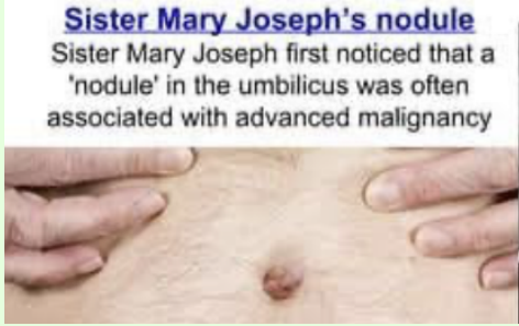 <p>Malignancy of the mid-GI tract, with adenocarcinoma being the most common </p><p>-Early Presentation: dyspepsia, vague abdominal pain in the elderly </p><p>-Late Presentation: weight loss, early satiety, anemia, melena, vomiting, Virchow node, Sister Mary Joseph nodule </p><p>-Dx: EGD with biopsy </p><p>-Tx: gastrectomy with lymph node dissection</p>