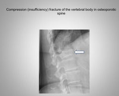 <p>Impaction (Compression) Fracture</p>