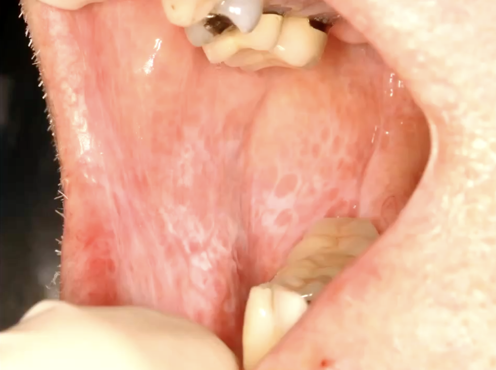 <p>what condition?</p><p>• Often asymptomatic</p><p>• Posterior buccal mucosa</p><p>• Lacy white striations (Wickham striae)</p><p>• almost always bilateral</p>