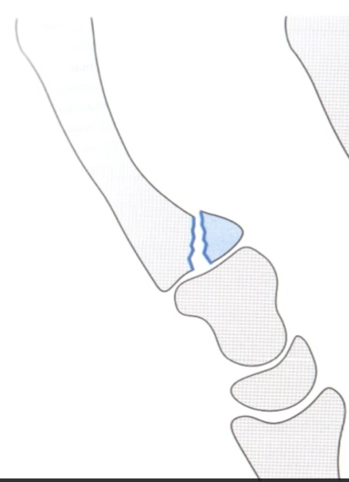 <ul><li><p><span>Oblique avulsion# of metacarpal base</span></p></li><li><p></p></li></ul><p></p>