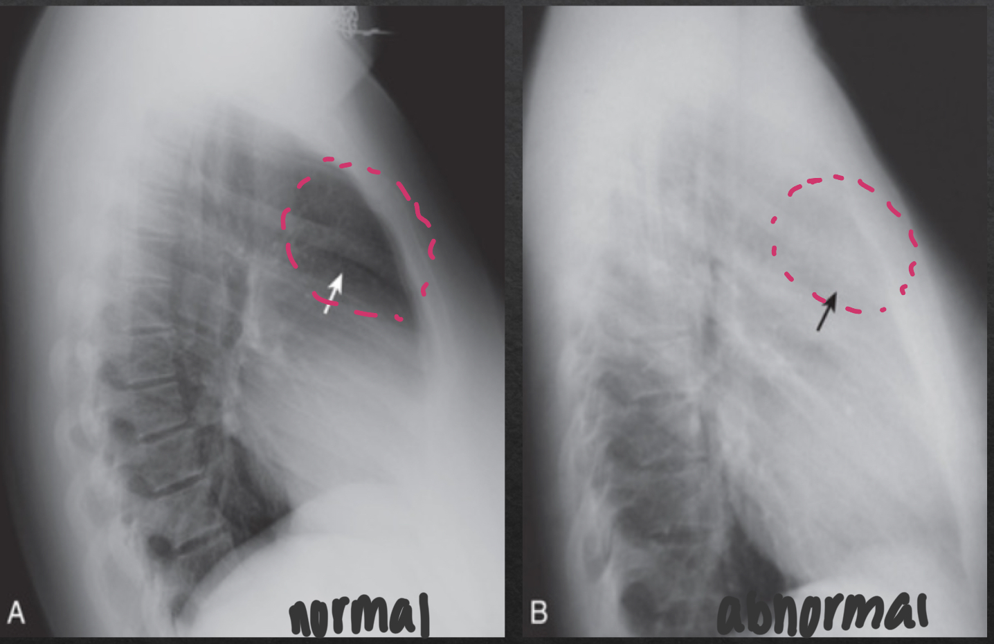<ul><li><p>NORMAL</p><ul><li><p><strong>lucent</strong> crescent btwn sternum and ascending aorta/anterior heart</p></li></ul></li><li><p>ABNORMAL</p><ul><li><p>soft tissue density filling normal space behind the sternum</p></li></ul></li></ul><p></p>