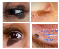 <p>What is the most likely diagnosis ?</p>