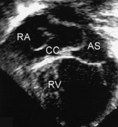 <ul><li><p>a freely mobile, lace/mesh-like membrane</p><ul><li><p>located in <span style="color: rgb(0, 116, 253);">RA </span>near <span style="color: rgb(0, 139, 255);">orifice of coronary sinus</span></p></li></ul></li><li><p><strong>embryonic remnant</strong></p><ul><li><p>similar to Eustachian</p></li></ul></li><li><p>seen in 2-3% of the pop</p></li><li><p>needs to be DDX’d from mass or tumor</p></li></ul><p></p>