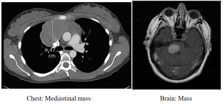 <p>CT and MRI Scan: staging</p>