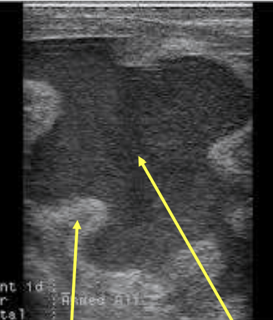<p>thick uterine wall and hypoechoic fluid in the uterine lumen</p>