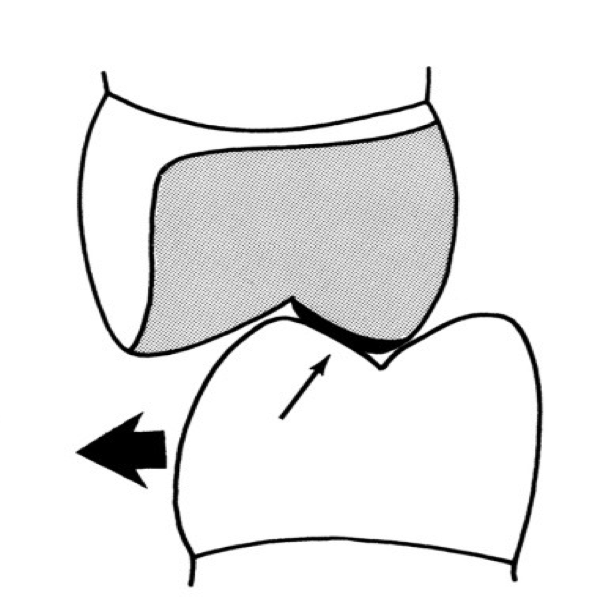 <p>A premature contact (small arrow) on the buccal incline of the maxillary palatal cusp produces a _________ shift (large arrow) of the mandible.</p>