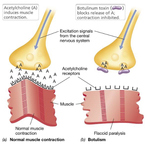 <ul><li><p>Botulinum toxin (BoNT) is an AB-type neurotoxin produced by <em>Clostridium botulinum</em>, with its genes found on the chromosome, plasmids, or prophage elements (most potent toxin known)</p></li><li><p>The B-subunit binds specifically to receptors on motor neurons; once inside, A-subunit acts as an endoprotease that cleaves SNARE proteins required for synaptic vesicle fusion</p></li><li><p>As a result, synaptic vesicles cannot merge with the presynaptic membrane, preventing the release of acetylcholine into the synaptic cleft; without acetylcholine muscle fibers cannot be stimulated, leading to flaccid paralysis</p></li></ul><p></p>