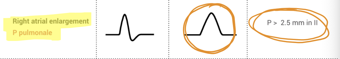 <p>observe the P waves: a larger initial (+) in V1, tall/peaked in II. (P wave height >2.5 mm) </p>