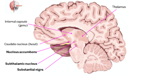 <p>thalamus, nucleus accumbens, subthalamic nucleus and substantia nigra evident </p>