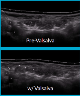 <ul><li><p>Increases intra-abdominal pressure</p></li><li><p><span style="background-color: transparent;">Have patients “bare down” like they’re preparing to take a punch to the abdomen</span></p></li><li><p><span style="background-color: transparent;">Contents move distally → hernia widens</span></p><ul><li><p>Contents move back toward abdomen and sac narrows during relaxation</p></li></ul></li><li><p><span style="background-color: transparent;">Key maneuver when looking for hernia due to dynamic study</span></p></li></ul><p></p>