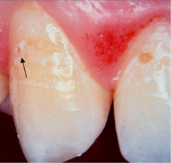 <p>What ICDAS score would be given to this tooth?</p>