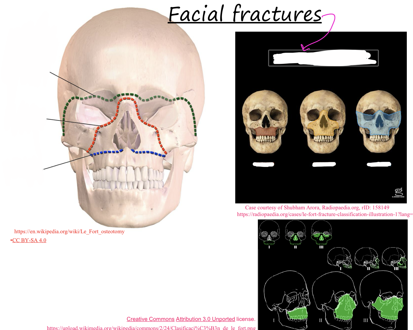 <p>What is the name of the skull fractures that involve the face (facial fx)</p>