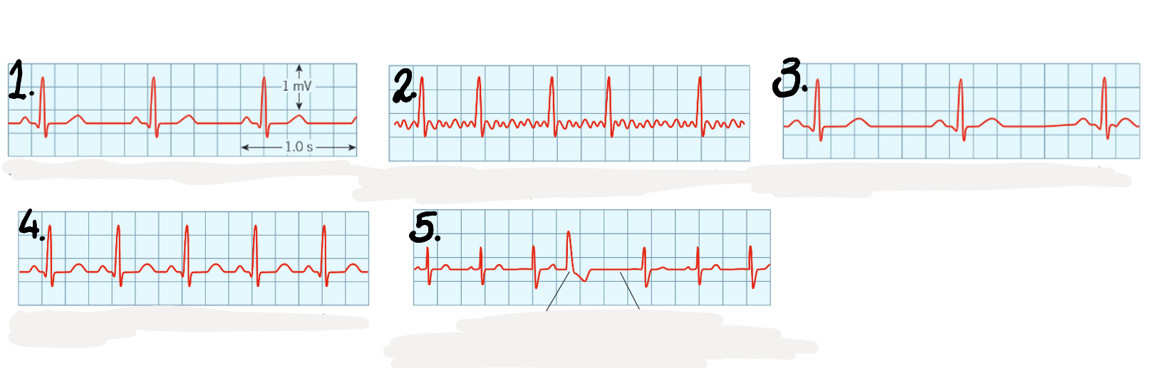 <p>which ECG is which different type of heart beat? how do you know? </p>