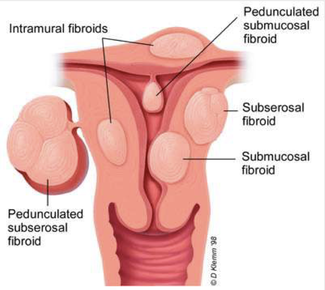 <p>Myomas (Uterine Fibroids) types</p>