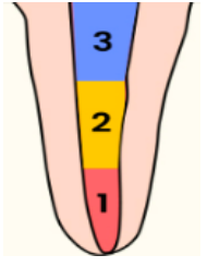 <p>use of <span>hand instruments</span></p><p>standardized preparation, roane balance force</p><p>step back preparation &amp; modifications by (schilder, weine, passive step back)</p><p>involves preparation of the <strong>apical third initially followed by middle and coronal third </strong>of the canal using larger instruments</p><p><span>coronal instrumentation with reaming motion and apical instrumentation with circumferential filing</span></p>