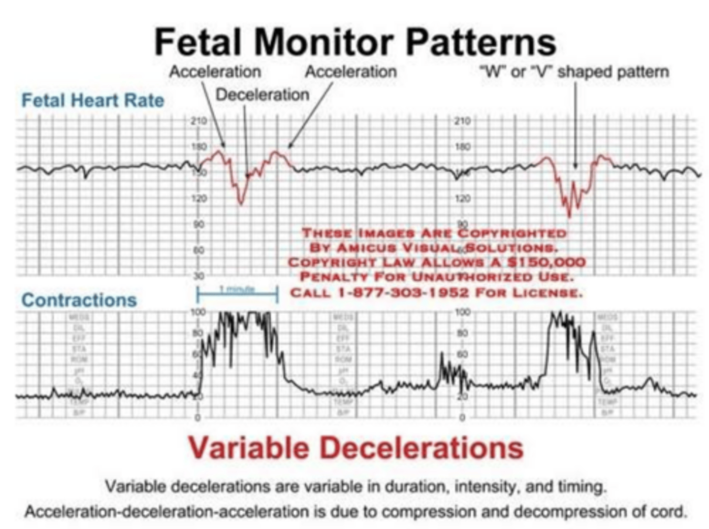 <p>Irregular dips in fetal heart rate seen with temporary cord compression</p>