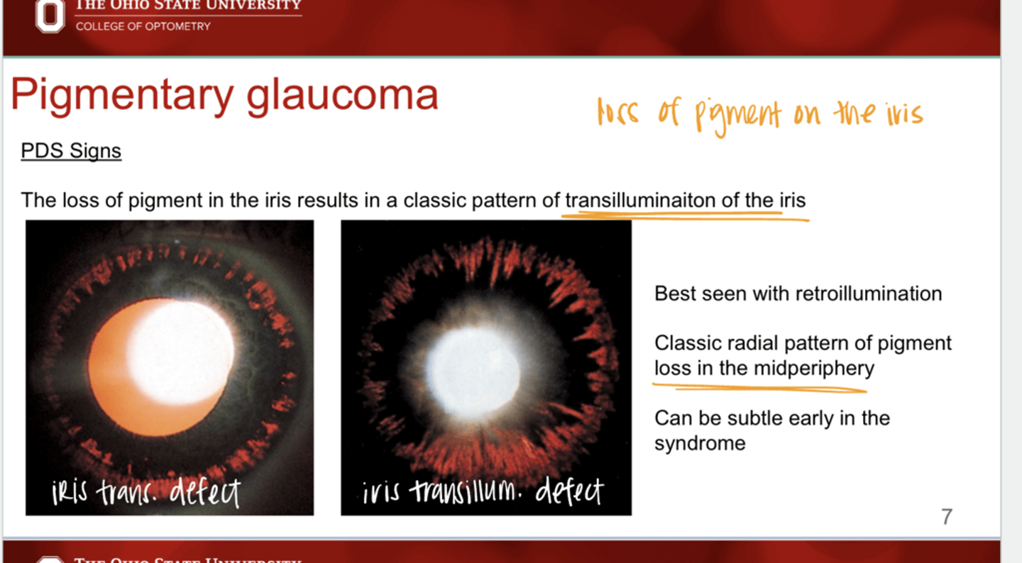 <p>The loss of pigment in the iris with PDS will result in the classic pattern of ________ of the iris</p>