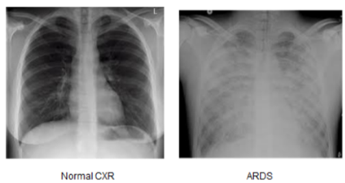 <p>caused by direct or indirect lung injury. 35-45% mortalityn</p><ul><li><p>injury → low bloodflow → RBC accumulation → inflammation → damage to alveolar membrane → increased capillary permeability → proteins + fluid leave into interstitial space → pulm edema</p></li><li><p>fluid in alveoli + low blood flow → alveoli damage → difficulty to produce surfactant → alveolar collapse → impaired gas exchange</p></li><li><p>RR raises but O2 can’t cross membrane. CO2 crosses easier → blood O2 and CO2 both drop</p></li><li><p>pulm edema worsens → inflammation causes ambrosia → worsened gas exchange → hypoxemia → r<strong>esp acidosis</strong></p></li></ul><p><u>SE:</u></p><ul><li><p>sudden and progressive pulm edema from inflammatory cascade (non-cardiac)</p></li><li><p><strong>severe hypoxemia that is unresponsive (refractory) to O2 therapy</strong></p></li><li><p>decreased lung compliance</p></li><li><p>dense pulm infiltrates with ground-glass appearance on chest x-ray (turning to fibrosis</p></li></ul><p><u>common comorbidities (don’t study)</u></p><ul><li><p><u>direct:</u> severe thoracic trauma, diffuse pulm infection. toxic gas, aspiration, prolonged mech vent use</p></li><li><p><u>indirect:</u> severe sepsis, shock, or anaphylaxis. severe nonthoracic trauma, pulm emboli, metabolic disorders, hematologic disorders, drug overdose/ingestion</p></li></ul><p><u>phases:</u></p><ul><li><p><strong>Phase 0 Acute Lung Injury</strong> 3ish days</p><ul><li><p><u>expected SE:</u> <strong>initial sever dyspnea</strong>, labored WOB, low PaO2 + SpO2, tachycardia, disorientation, anxiety</p></li><li><p><u>possible SE:</u> fever, diaphoresis, hypotension, crackles</p></li></ul></li><li><p><strong>Phase 1</strong> ARDS - Exudative, 7-10 days</p><ul><li><p><u>SE:</u> low surfactant, crackles, </p></li><li><p><u>diagnose:</u></p><ul><li><p>chest x-ray → diffuse bilateral infiltrates</p></li><li><p>ABGs → resp acid</p></li><li><p>hypocapnea, PaO2 <60</p></li><li><p>cardiac tests to rule out cardiac origin</p></li></ul></li></ul></li></ul><ul><li><p><strong>Phase 2</strong> - Fibroproliferative, weeks to months</p><ul><li><p><u>repair:</u> dead cells removed → fluids dissipate → alveoli repaired → surfactant produced</p></li></ul></li><li><p><strong>Phase 3</strong> - Fibrotic, weeks to months</p><ul><li><p>50% mortality</p></li><li><p><u>resolution</u></p><ul><li><p><u>SE:</u> ventilator, long-term care facility, barotrauma</p></li></ul></li><li><p><u>fibrosis:</u> irreversible, higher mortality</p><ul><li><p><u>SE:</u> multi-organ dysfunction, vent dependent, barotrauma, </p></li></ul></li></ul></li></ul><p></p><p><u>mgmt:</u></p><ul><li><p>vent support - high peep/FiO2 (to keep lungs open), small tidal volumes (prevent barotrauma in alveoli)</p></li><li><p>positioning - HOB elevated, or prone (allows the fluid to enter diff alveoli so the wet alveoli get a break, + taking heart weight off lungs helps w breathing)</p></li><li><p>nutrition - enteral or TPN</p></li><li><p>circ support - <strong>conservative fluids</strong> + monitor UOP</p></li><li><p>drugs - diuretics, antibiotics</p></li><li><p>sedation to help patient accept the high WOB from ventilator</p></li><li><p>ECMO (extracorporeal membrane oxygenation; removes blood, adds O2 and removes CO2, puts it back in), oxygenation</p></li></ul><p></p>