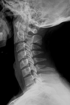<p>clay shoveler’s fx- radiographic appearance </p>