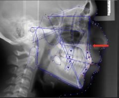 <p>which anatomical landmark:</p><p>- The tip of the anterior nasal spine</p>