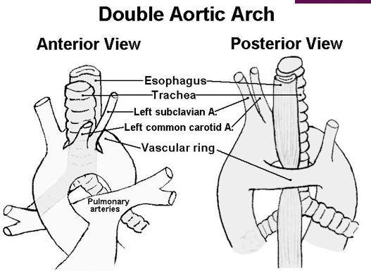 <p>vascular ring</p><ul><li><p>vascular structures encircling and compressing the esophagus/trachea </p></li><li><p>two transverse arches cross trachea and both bronchi </p></li></ul><p></p>
