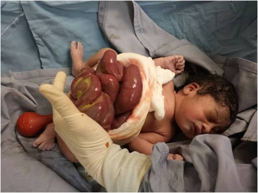 <p>Defecto congénito en la pared abdominal del feto por el cual los intestinos y otros órganos salen de la cavidad y quedan expuestos directamente al líquido amniótico, ya que no están recubiertos por una membrana. </p>
