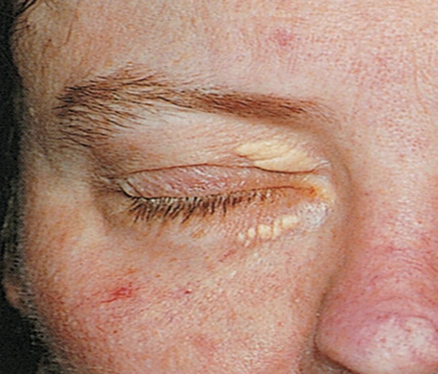 <p>localized lipid deposition on the eyelids</p>