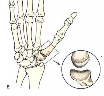 <p>Synovial Joint: Concaved/convexed bones that glide up and down </p>