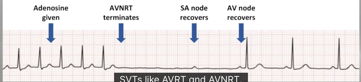 <ul><li><p>Transient depression of SA node and AV node</p></li><li><p>Temporary AV nodal block</p></li><li><p><strong>Cardioversion of AV nodal dependent SVTs (AVRT, AVNRT)</strong></p></li><li><p>Diagnosis of non AV nodal dependent SVTs (AT, AFlutter)</p></li></ul><p></p>