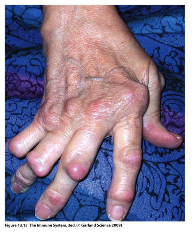 <p>Rheumatoid Factor (anti-Ig auto-Ab)</p>