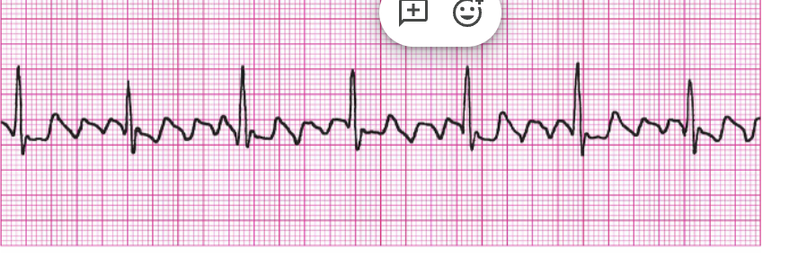 <ul><li><p><span style="background-color: transparent; font-family: "Times New Roman", serif;">Regularity: Atrial rhythm is usually regular; ventricular rhythm is usually regular but can be irregular if there is variable block</span></p></li><li><p><span style="background-color: transparent; font-family: "Times New Roman", serif;">Rate: Atrial rate 250–350 bpm; ventricular rate varies</span></p></li><li><p><span style="background-color: transparent; font-family: "Times New Roman", serif;">P Wave: Characteristic sawtooth pattern (F waves)</span></p></li><li><p><span style="background-color: transparent; font-family: "Times New Roman", serif;">PRI: Unable to determine</span></p></li><li><p><span style="background-color: transparent; font-family: "Times New Roman", serif;">QRS: Less than 0.12 second</span></p></li></ul><p></p>