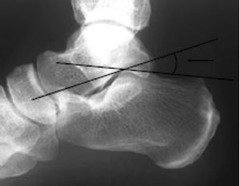 <p>tenderpoint of plantar fascia</p>
