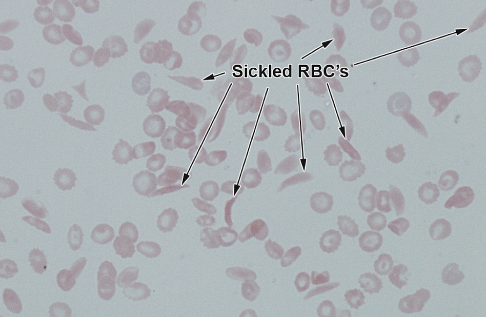 <p>Disorder with hard, rigid, and sickle shaped red blood cells </p>