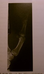 <p>During a thumb x-ray, what must you include?</p>