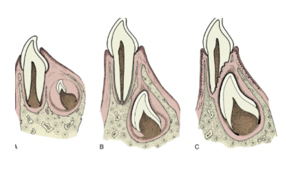 <ul><li><p><span style="background-color: transparent; font-family: "Times New Roman", serif;">Horses have 2 sets of teeth:&nbsp;</span></p><ul><li><p><span style="background-color: transparent; font-family: "Times New Roman", serif;">Temporary = deciduous teeth, milk teeth, or baby teeth</span></p><ul><li><p><span style="background-color: transparent; font-family: "Times New Roman", serif;">Begin to erupt in pairs, sometimes before birth</span></p></li></ul></li><li><p><span style="background-color: transparent; font-family: "Times New Roman", serif;">Permanent: begin to replace after 2.5 yrs</span></p><ul><li><p><span style="background-color: transparent; font-family: "Times New Roman", serif;">Start with center incisors</span></p></li><li><p><span style="background-color: transparent; font-family: "Times New Roman", serif;">By 5 yrs, most horses have full permanent set</span></p></li></ul></li></ul></li><li><p><span style="background-color: transparent; font-family: "Times New Roman", serif;">Only one set of permanent molars!!</span></p></li></ul><p></p>