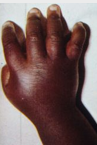 <p>inflammation/swelling of fingers or toes as a result or acute sickle cell</p><p>6 months</p><p>treatments: would give anti-inflammatory (ketorolac), penicillin everyday, give opioid as if they had a VOE in arm/leg, IV fluids</p>
