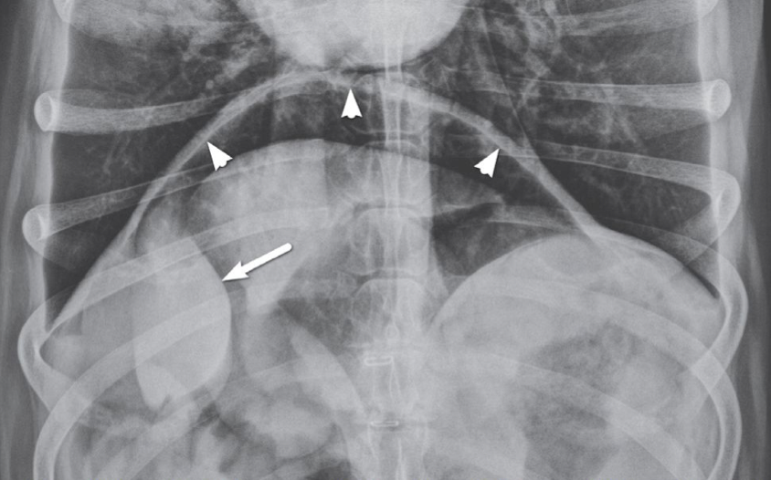 <p>What is indicated by the arrowheads in this image and what does it indicate</p>