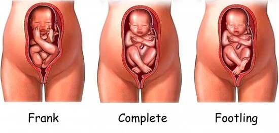 <p>Where should you place the stethoscope/Doppler to hear FHR in a breech presentation?</p>