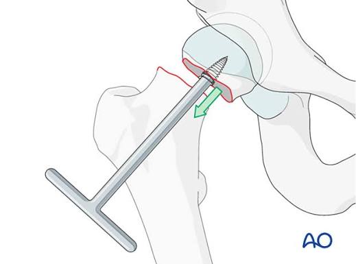 <p>Threads into the femoral head to remove it after the neck cut (all hips).</p>