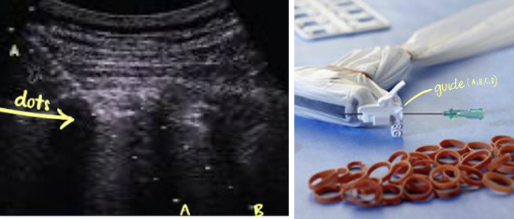 <ul><li><p>mechanically guided and attaches to transducer</p></li><li><p>depicts a path on the US machine as a single line or two parallel lines</p></li><li><p>may offer choices of angles</p></li><li><p>keeps the needle aligned with the beam for continuous needle visualization </p></li></ul><p></p>