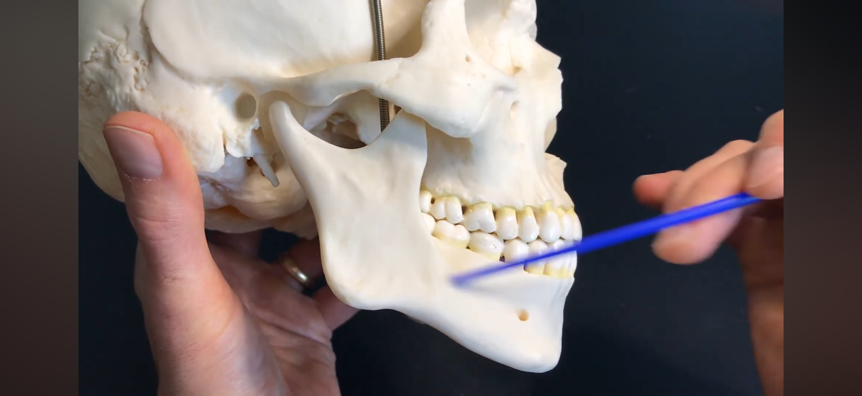 <p>What PART of the mandible is this?</p>