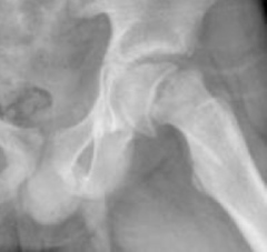 <p>X-Ray: AP, Lateral, and frog-leg of BOTH hips</p><p>S-Sign: on frog-leg, sharp discontinuity of the normal S shape of femoral head and neck</p><p>MRI can pick up pre-slip conditions (edema)</p>