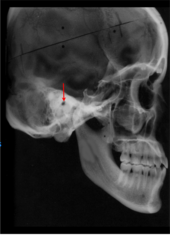 <p>which anatomical landmark:</p><p>- Highest point of the ear canal</p><p>- Most superior point of the external auditory meatus</p><p>- Immediately distal to the condyle</p>