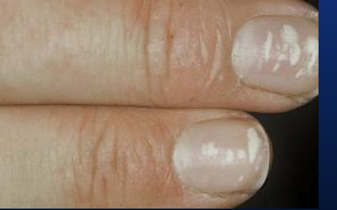 <p>White spots on the nail plate caused by low albumin levels or injury to the nail matrix.</p>