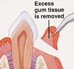 <p>Excision of the soft tissue wall of a pathologically deepened gingival crevice or periodontal pocket.</p><p>(Explanation: A gingivectomy removes excess gingival tissue to eliminate periodontal pockets or improve aesthetics. It's typically performed when pockets are suprabony and don't involve bone loss, focusing on soft tissue reshaping. This procedure is less invasive than flap surgeries but sacrifices keratinized tissue, which is critical for gingival health.)</p>