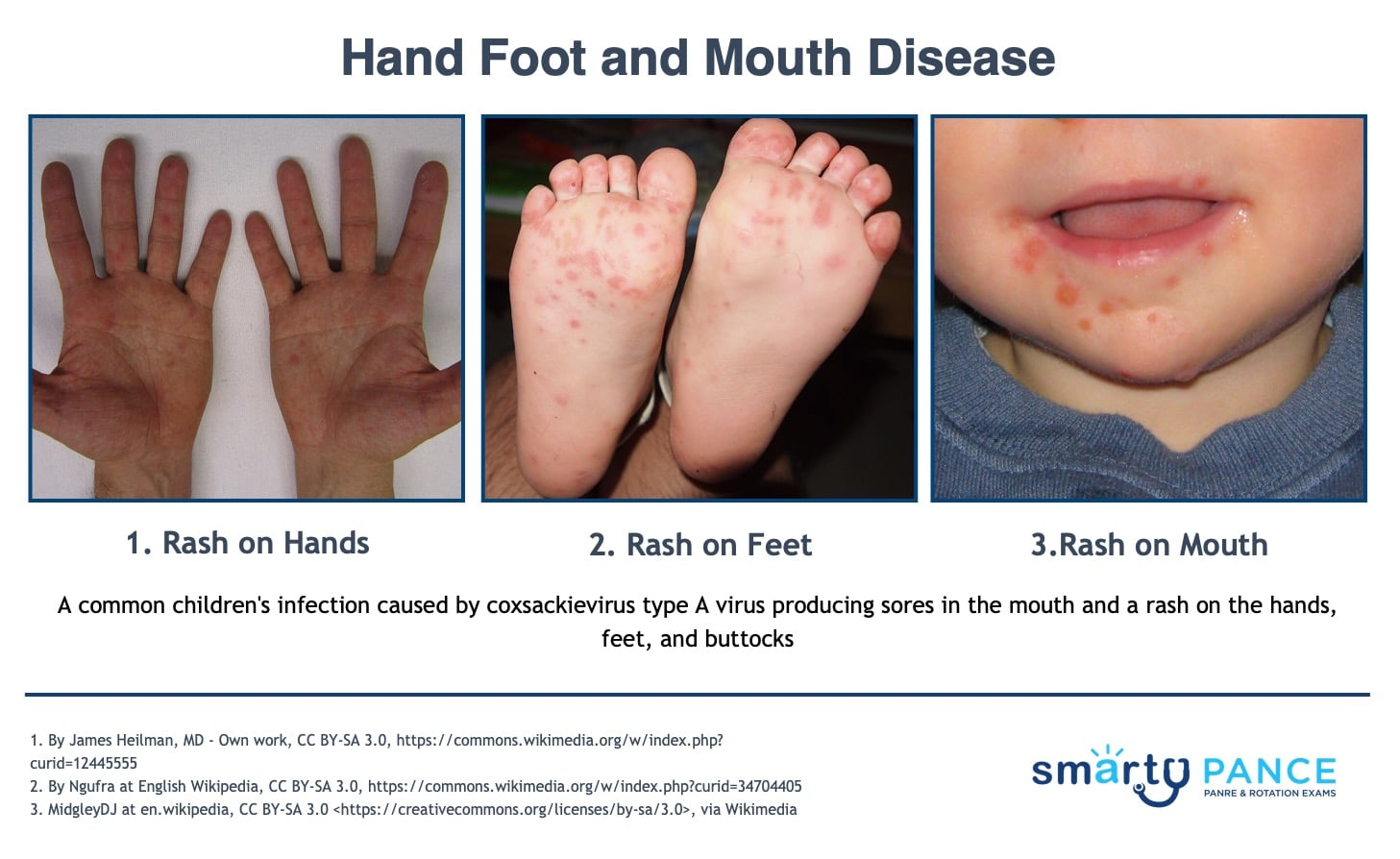 <p>Very contagious infection due to Coxsackievirus A16, spread via fecal-oral and respiratory droplets</p><p>-Presentation: prodromal symptoms of low grade fever, malaise, and sore mouth for 1-2 days then develop painful oral ulcers, vesicles on the palms/soles/backs of hands and feet </p><p>-Dx: clinical </p><p>-Tx: supportive, self-limited </p>