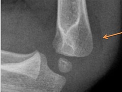 <p>always pathologic; visible only when effusion displacees it out of the olecranon fossa</p>